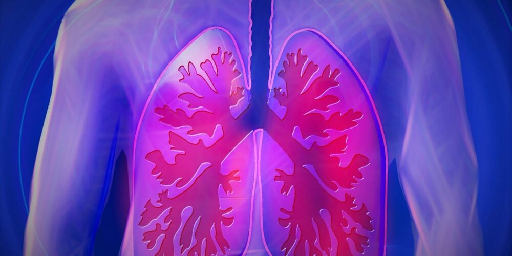 Common asbestos lung disease does not increase risk of lung cancer